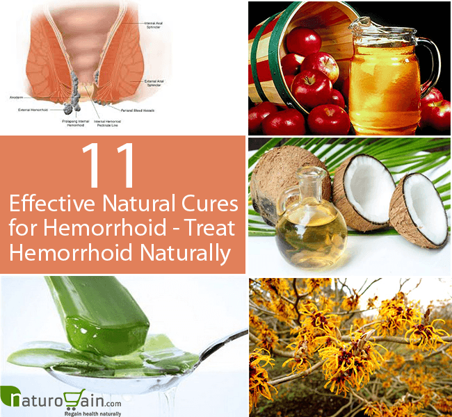 11 Effective Natural Cures for Hemorrhoid