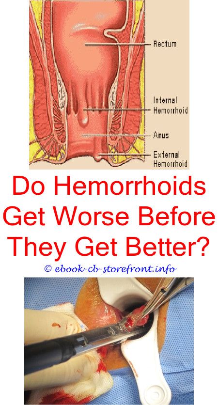 11+ Indescribable Hemorrhoid Remedies Fast Ideas