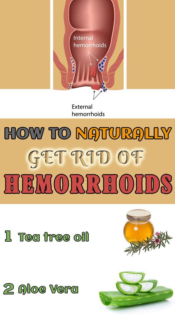 14 best How to Get Rid of Hemorrhoids images on Pinterest ...