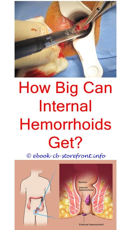 14+ Enticing Hemorrhoid Relief Ideas