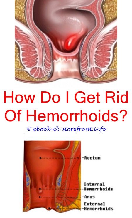 16+ Unearthly Hemorrhoid Relief How To Get Rid Ideas ...