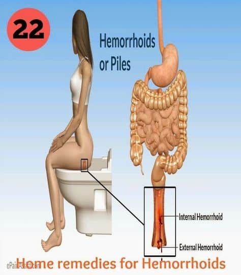22 Home Remedies for Hemorrhoids (With images)