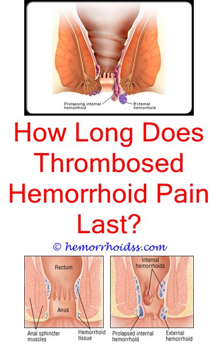 3 Awesome Unique Ideas: How Do You If You Have Hemorrhoids ...