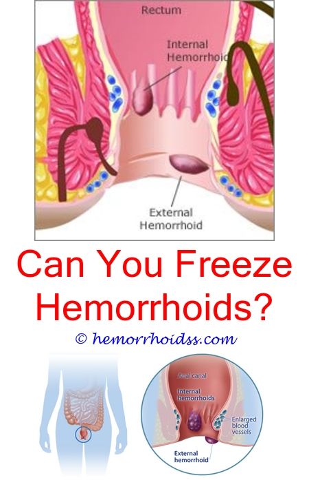 3 Crazy Tips and Tricks: What Do Outy Hemorrhoids Look ...