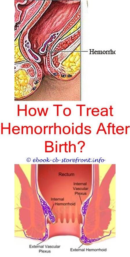 3 Stupefying Ideas: Can Hemorrhoids Give You Diarrhea can ...