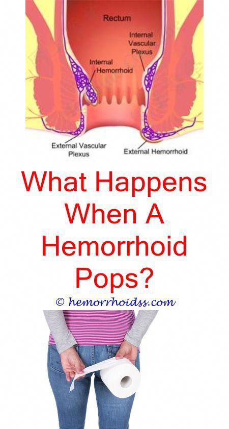 4 Mind Blowing Ideas: What Causes Prolapsed Hemorrhoids ...
