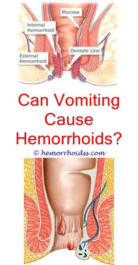 4 Unbelievable Tricks: How Do You Fix Bleeding Hemorrhoids ...