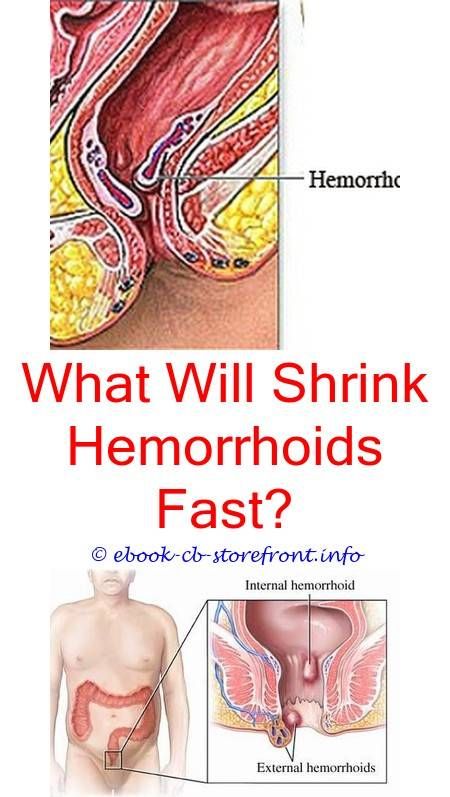 5 Creative And Inexpensive Unique Ideas: Hemorrhoid ...