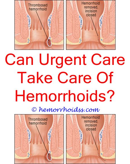 5 Impressive Tips Can Change Your Life: How To Heal Hemorrhoids ...