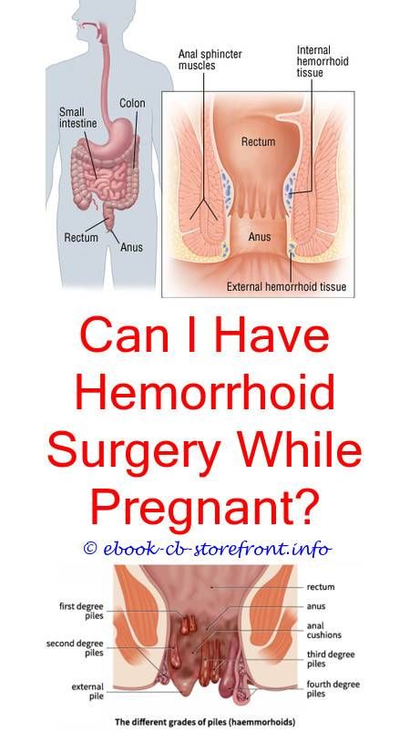5 Wealthy ideas: Can Hemorrhoid Banding.be Performed By ...