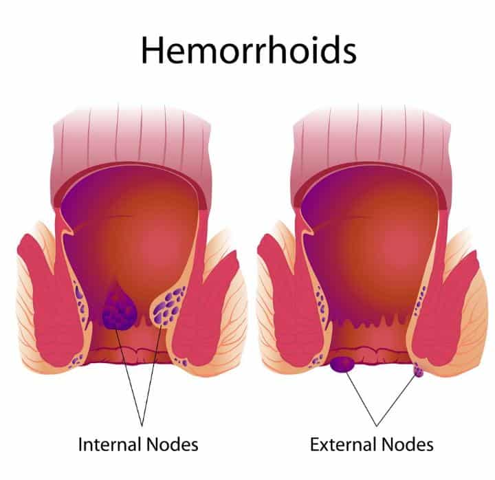 6 Easy Ways to Prevent Hemorrhoids