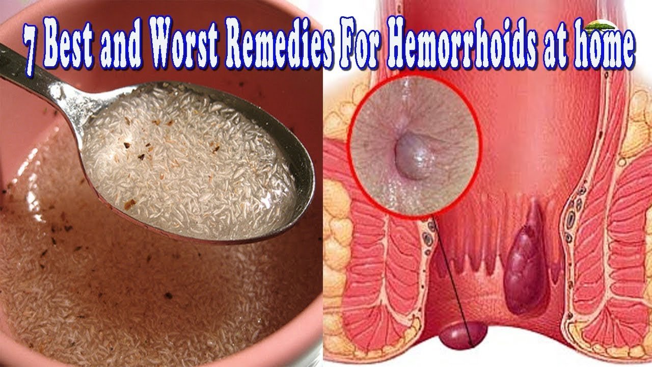 7 Best and Worst Remedies For Hemorrhoids at home ...