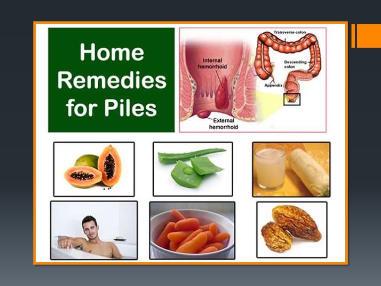 8 home remedies for hemorrhoids