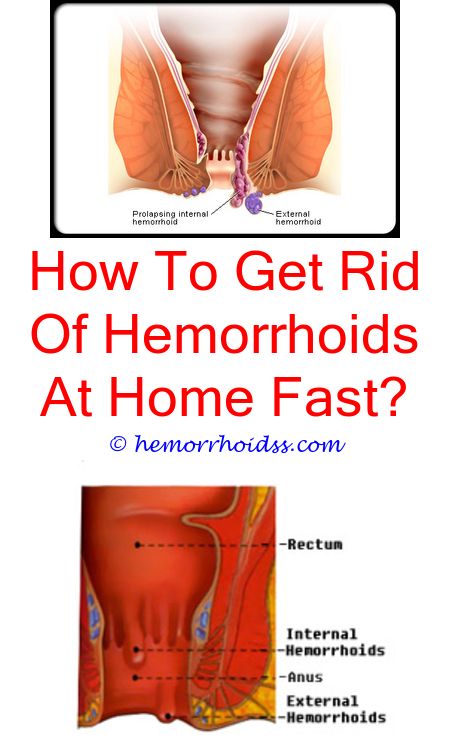8 Wondrous Diy Ideas: How Do You Get Rid Of Hemorrhoids ...