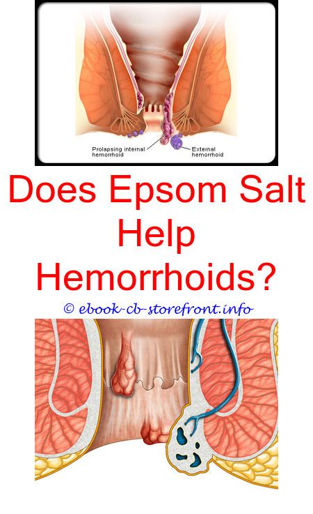 9 Enormous Tips: How Can You Prevent Hemorrhoids From ...
