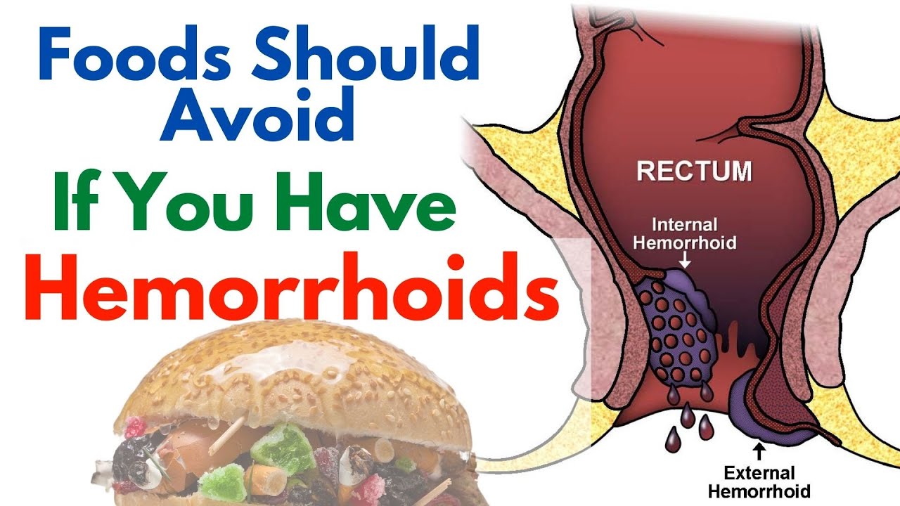 9 Foods That Make Hemorrhoids Worse