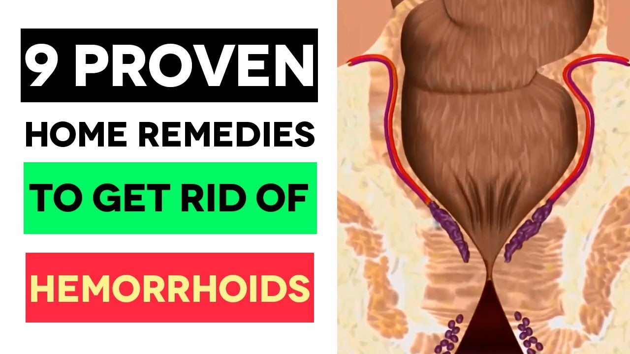 9 PROVEN Home Remedies To Get Rid Of Hemorrhoids. (Treat ...