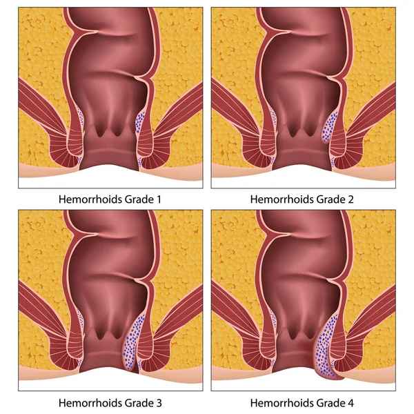 á? Graphic hemorrhoids stock pictures, Royalty Free hemorrhoids vectors ...