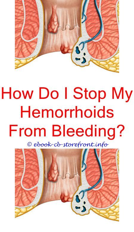 Addressing hemorrhoids can be tricky and needs you to try ...