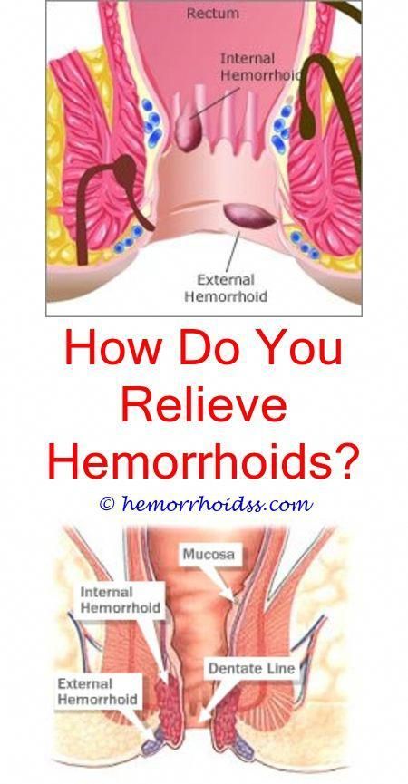 Addressing hemorrhoids could be difficult and needs you to ...