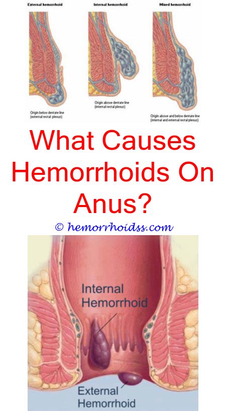 Amazing Tricks: Can You Have Hemorrhoids For Years? can u ...