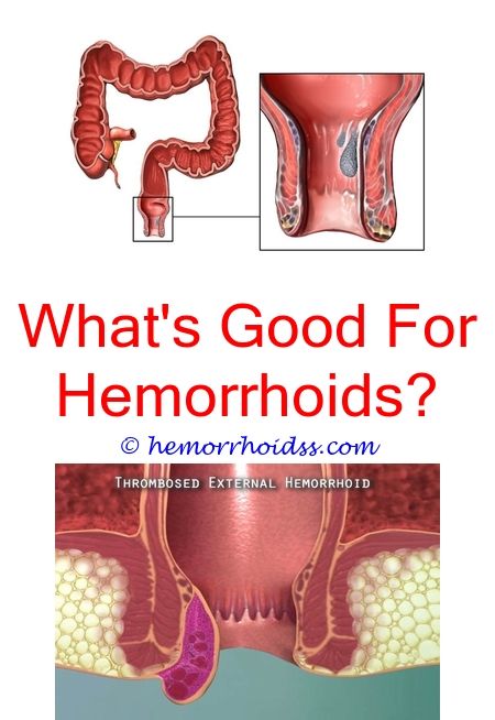 Are Hemorrhoids Curable?