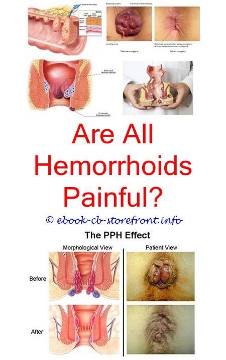 Best Cool Ideas: How To Deal With A Small Hemorrhoid how ...