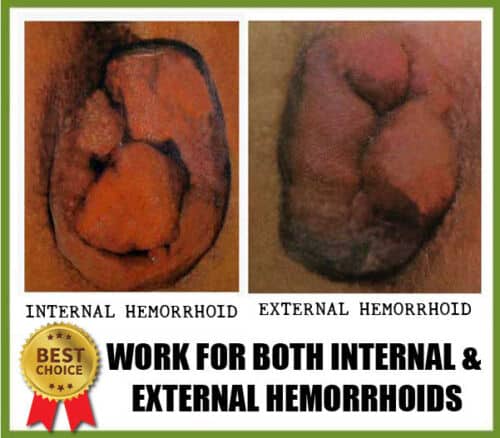 Best INTERNAL &  EXTERNAL HEMORRHOID treatment ! Cure it NATURALLY ...