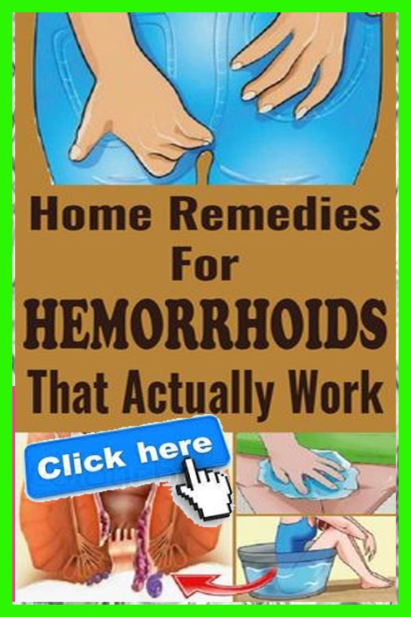 Best way to get rid of hemorrhoids fast in 2020