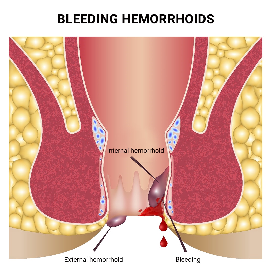Bleeding Hemorrhoids: When to See a Doctor