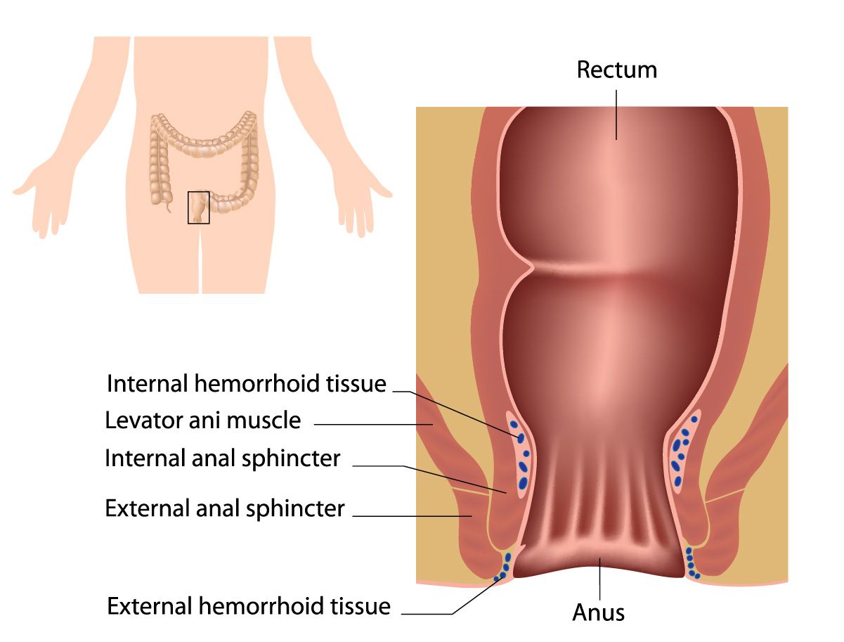 Blood In Stool Either Hemroids Or Cancer How To Tell