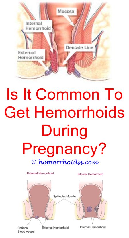 Can Diarrhea Cause Hemorrhoids To Flare Up?