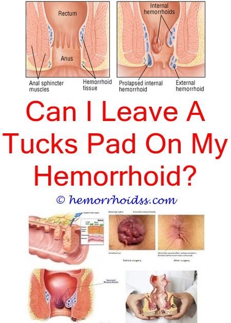 Can Hemorrhoids Cause Back And Leg Pain? what happens if i ...