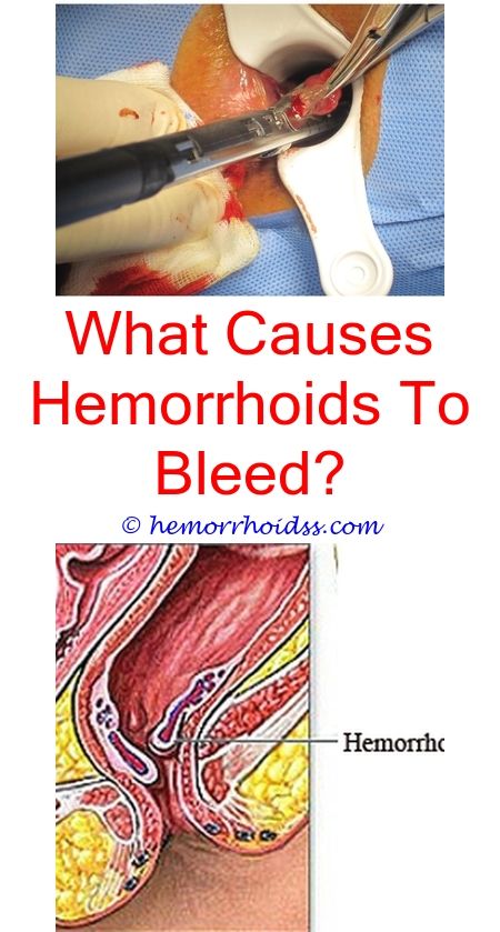 Can Hydrocortisone Cream Be Used For Hemorrhoids ...