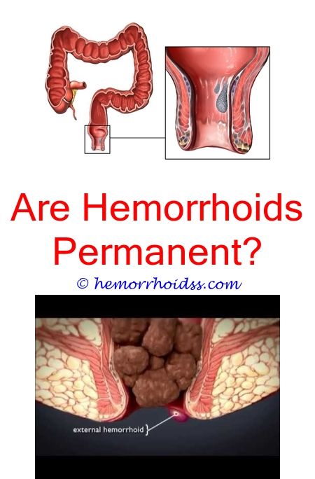 Can I Drain A Thrombosed Hemorrhoid Myself?