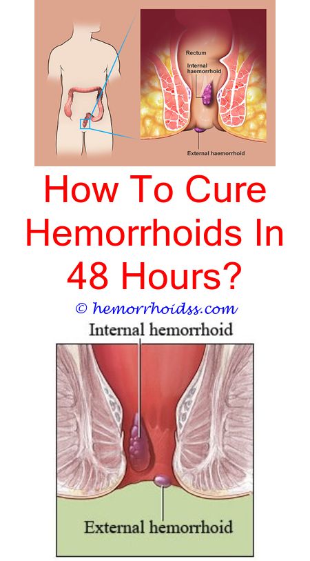 Can I Workout With A Hemorrhoid