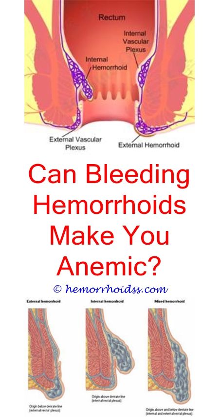 Can Internal Hemorrhoids Become Thrombosed? can the er do anything for ...