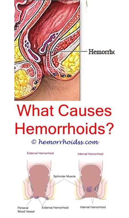 Can suppositories for hemorrhoids cause diarrhea?.Do core ...