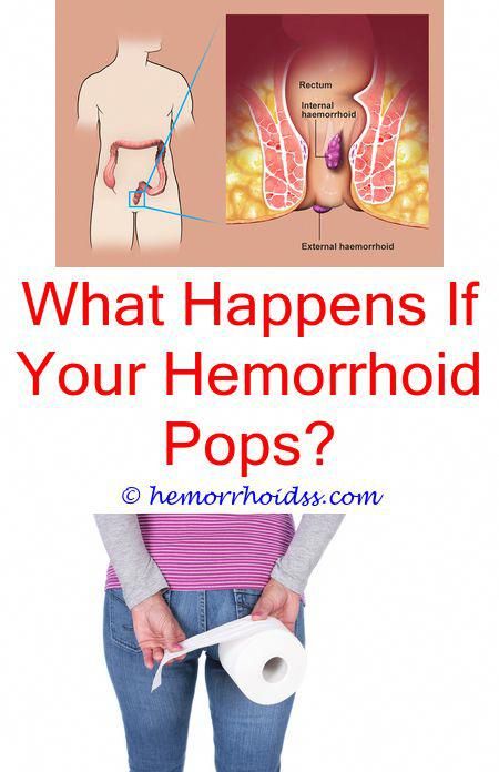 Can You Drain External Hemorrhoids? how to heal internal hemorrhoids ...