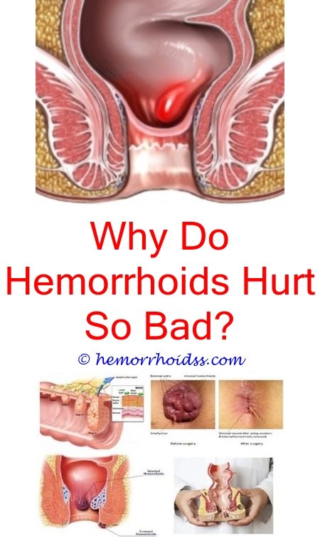 Can You Pop A Hemorrhoid Like A Pimple?