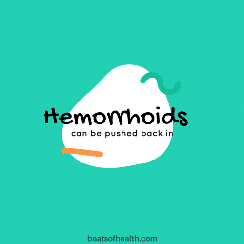 Can You Push Your Hemorrhoids Back In?