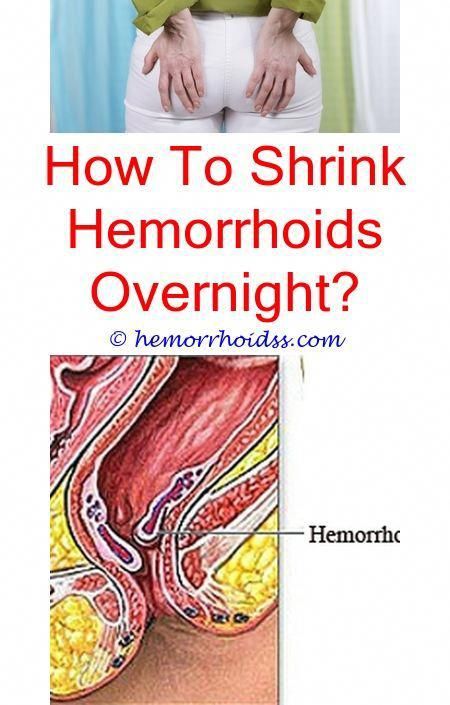 Can You Use Hemorrhoid Cream For A Yeast Infection? can ...