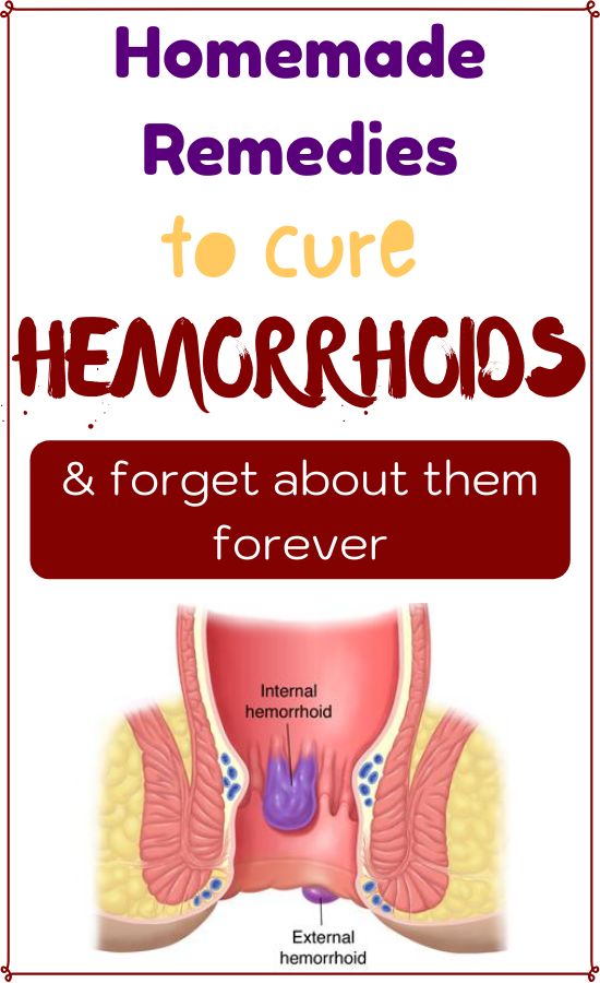 Check how to control hemorrhoids if you have them ...