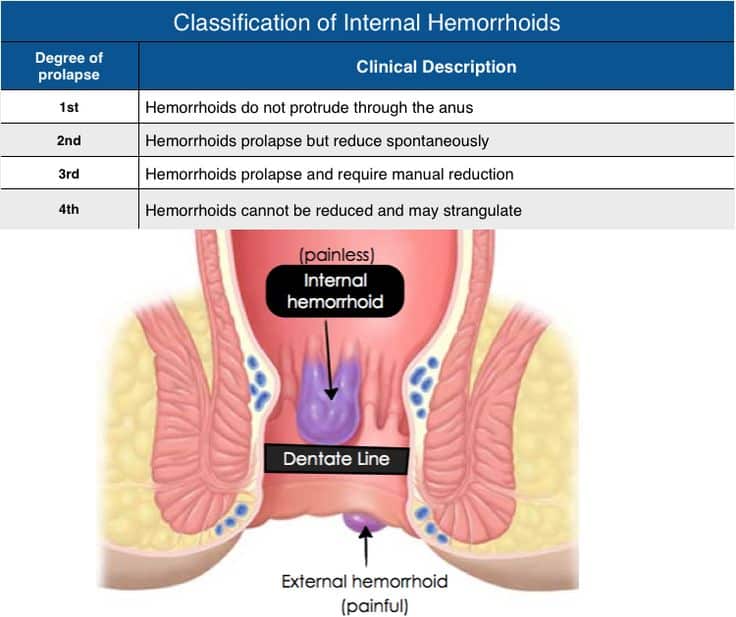 Classification of Internal Hemorrhoids Rosh Review