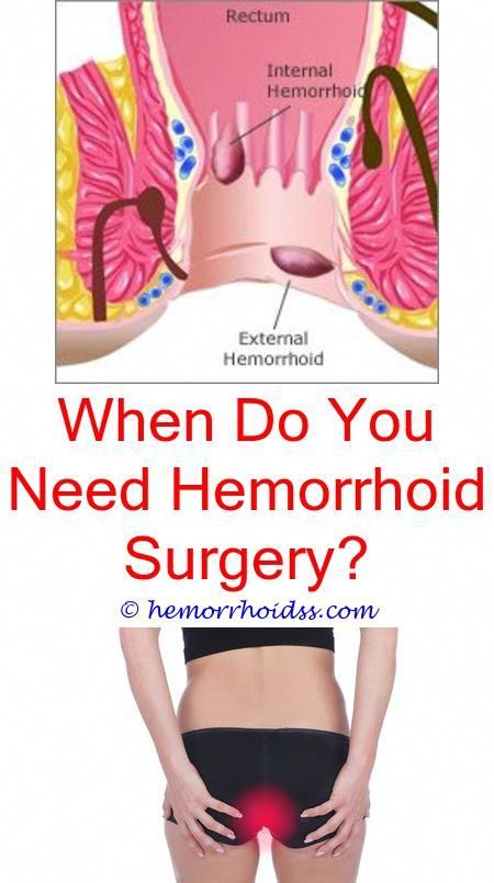 Crazy Tips and Tricks: Can I Push My Hemorrhoid Back In ...