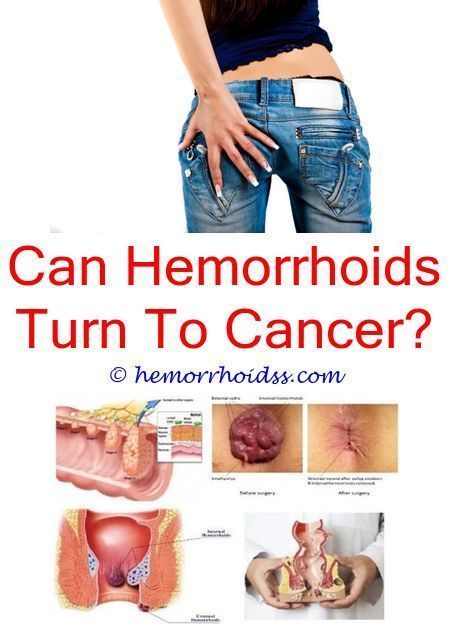 Dealing with hemorrhoids could be tricky and requires you ...