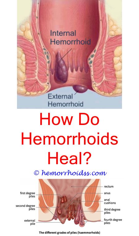 Do Hemorrhoids Bleed When They Burst?