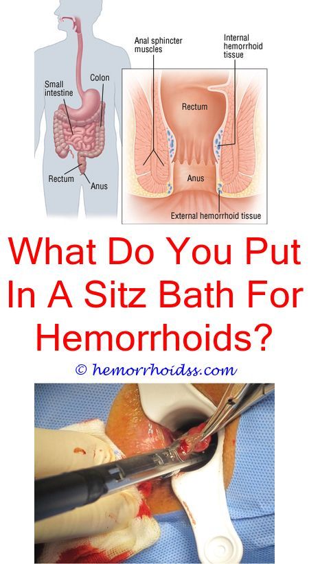 Do hemorrhoids go away on its own. Do hemorrhoids go away ...