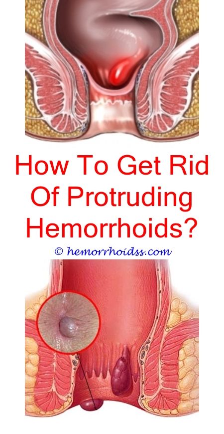 Do Hemorrhoids Go Away On Its Own? (With images ...