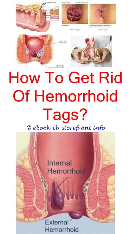 Do Hemorrhoids Skin Tags Go Away